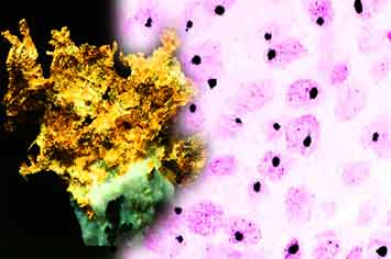 Gold nugget and super-sebnsitive nahnogold-silver in situ hybridization. Black dots show single copies of human papillomavirus (HPC) 16/18 DNA in cancer cell nuclei of squamous cell carcinoma of the human cervix. (c) Univ.-Prof. Dr. Gerhard W. Hacker, Salzburg (2004).